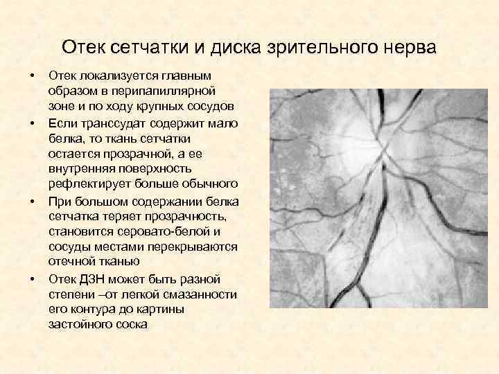 Отек сетчатки и диска зрительного нерва • • Отек локализуется главным образом в перипапиллярной