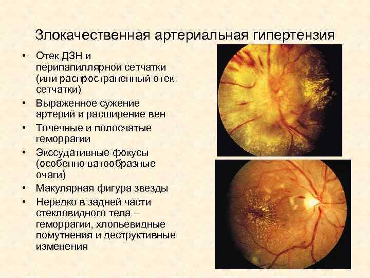 Злокачественная артериальная гипертензия • Отек ДЗН и перипапиллярной сетчатки (или распространенный отек сетчатки) •