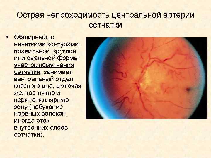 Острая непроходимость центральной артерии сетчатки • Обширный, с нечеткими контурами, правильной круглой или овальной