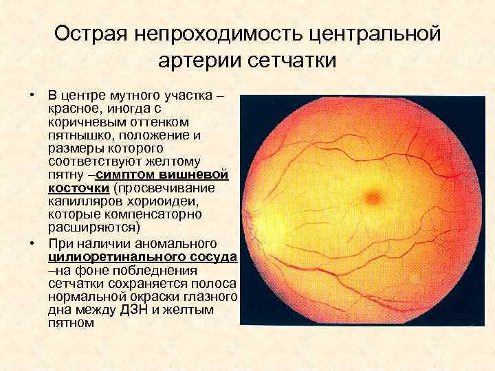 Острая непроходимость центральной артерии сетчатки • В центре мутного участка – красное, иногда с