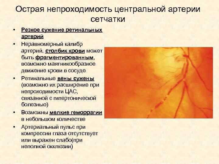 Острая непроходимость центральной артерии сетчатки • • • Резкое сужение ретинальных артерий Неравномерный калибр