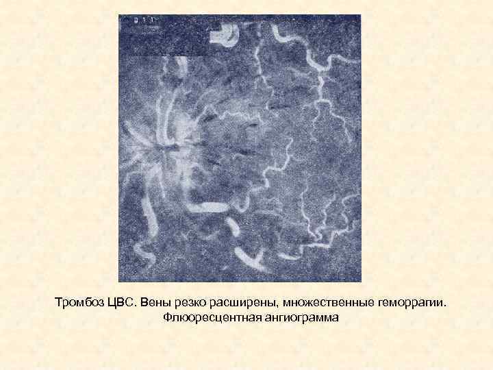 Тромбоз ЦВС. Вены резко расширены, множественные геморрагии. Флюоресцентная ангиограмма 