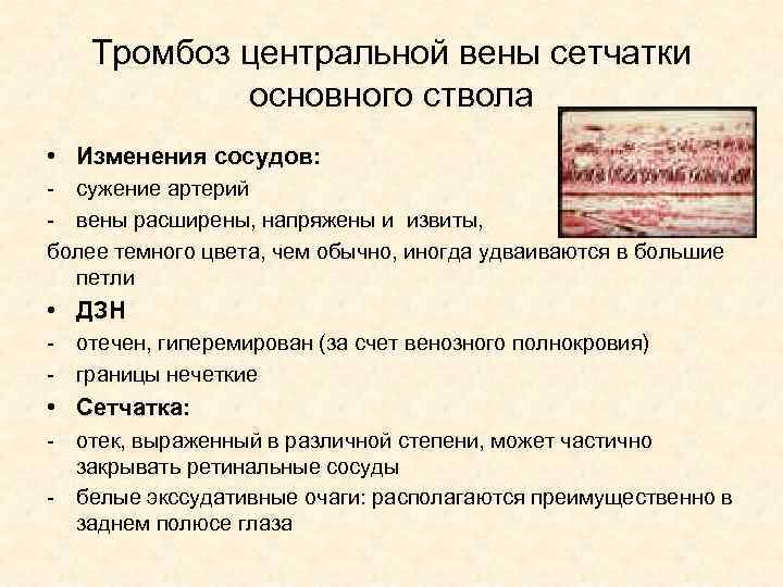 Тромбоз центральной вены сетчатки основного ствола • Изменения сосудов: - сужение артерий - вены