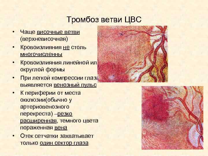 Тромбоз ветви ЦВС • Чаще височные ветви (верхневисочная) • Кровоизлияния не столь многочисленны •