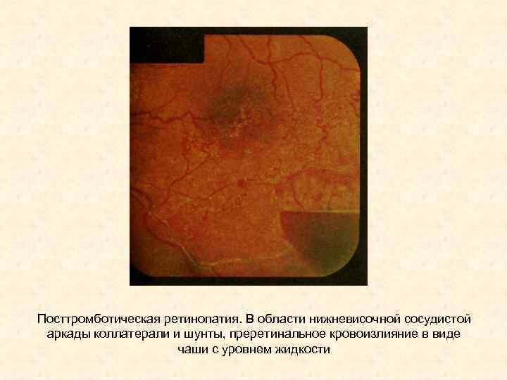 Посттромботическая ретинопатия. В области нижневисочной сосудистой аркады коллатерали и шунты, преретинальное кровоизлияние в виде