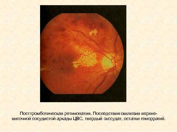 Посттромботическая ретинопатия. Последствия окклюзии верхневисочной сосудистой аркады ЦВС, твердый экссудат, остатки геморрагий. 