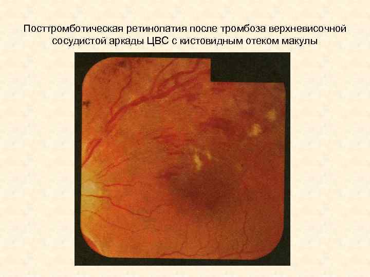 Посттромботическая ретинопатия после тромбоза верхневисочной сосудистой аркады ЦВС с кистовидным отеком макулы 