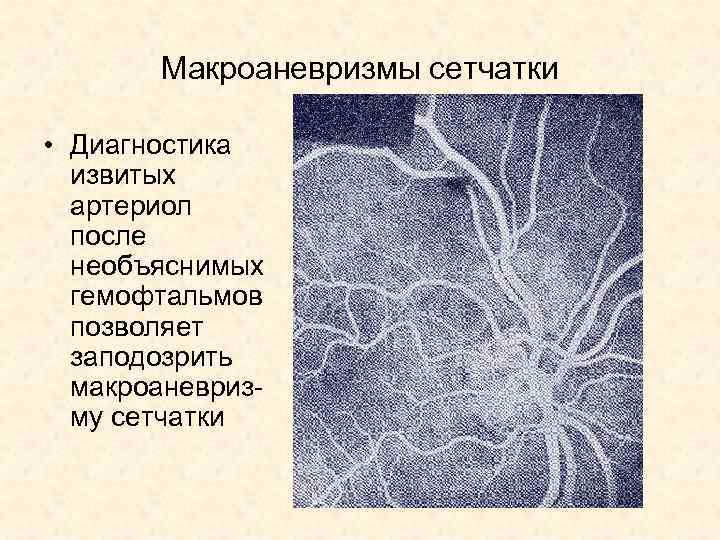 Макроаневризмы сетчатки • Диагностика извитых артериол после необъяснимых гемофтальмов позволяет заподозрить макроаневризму сетчатки 