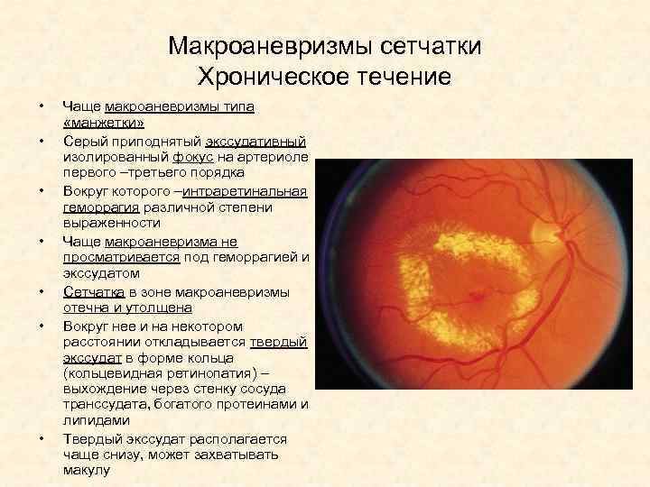 Макроаневризмы сетчатки Хроническое течение • • Чаще макроаневризмы типа «манжетки» Серый приподнятый экссудативный изолированный