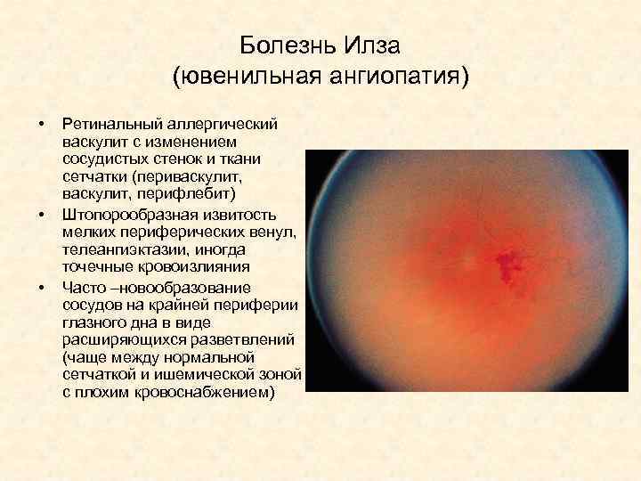 Болезнь Илза (ювенильная ангиопатия) • • • Ретинальный аллергический васкулит с изменением сосудистых стенок