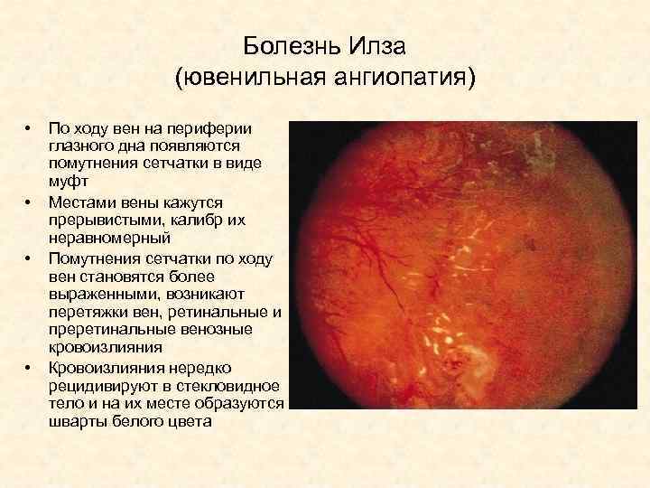 Болезнь Илза (ювенильная ангиопатия) • • По ходу вен на периферии глазного дна появляются