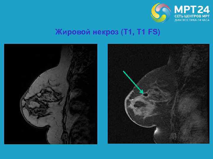 Жировой некроз (Т 1, Т 1 FS) 