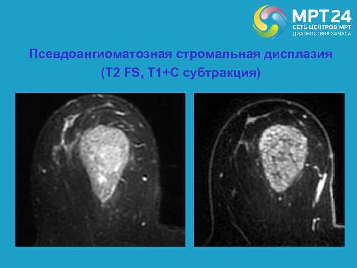 Псевдоангиоматозная стромальная дисплазия (Т 2 FS, Т 1+С субтракция) 