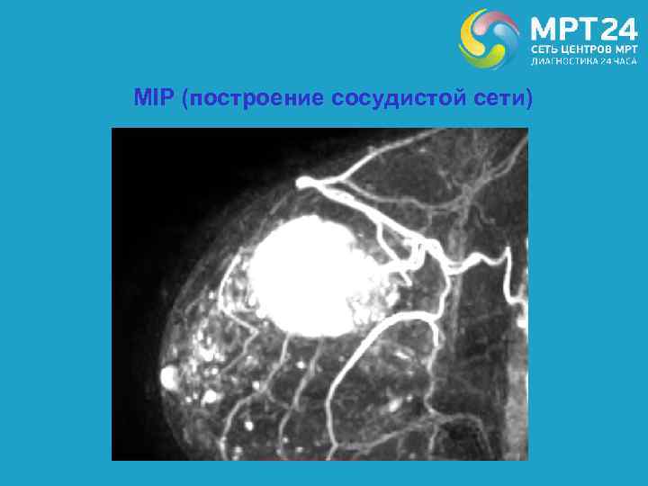 MIP (построение сосудистой сети) 