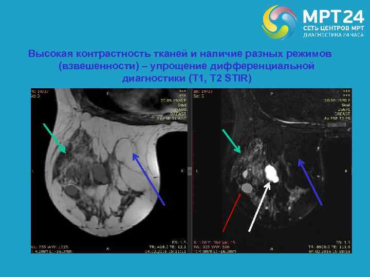 Высокая контрастность тканей и наличие разных режимов (взвешенности) – упрощение дифференциальной диагностики (Т 1,