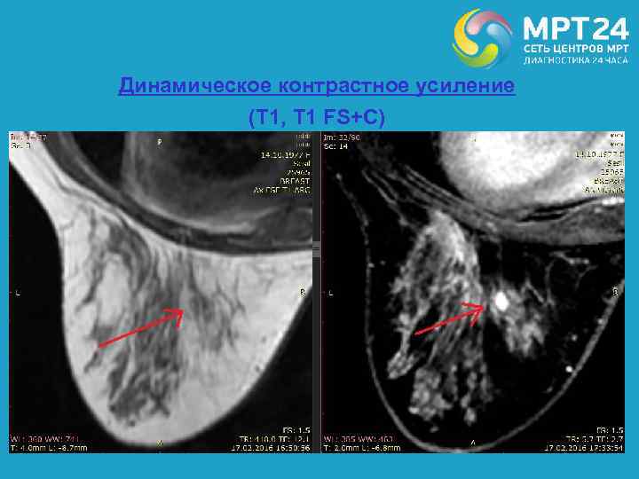 Динамическое контрастное усиление (Т 1, Т 1 FS+С) 