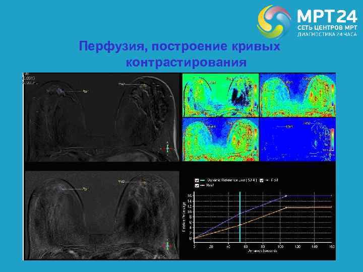 Перфузия, построение кривых контрастирования 