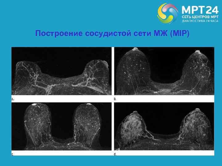 Построение сосудистой сети МЖ (MIP) 