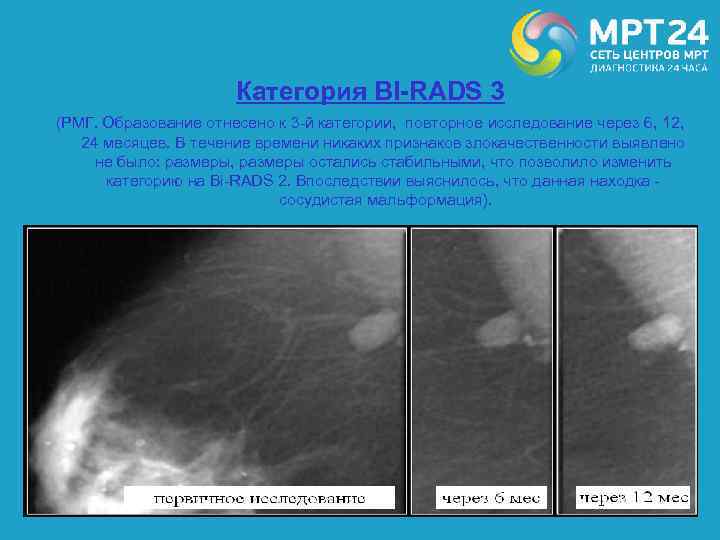 Категория BI-RADS 3 (РМГ. Образование отнесено к 3 -й категории, повторное исследование через 6,