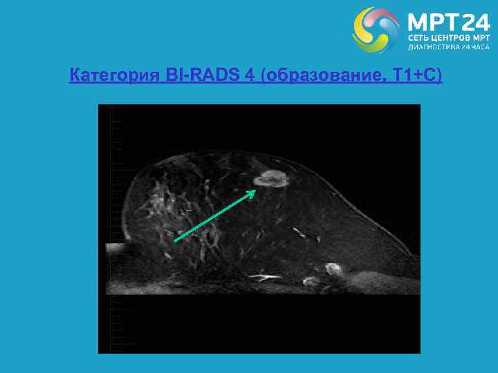 Категория BI-RADS 4 (образование, Т 1+С) 