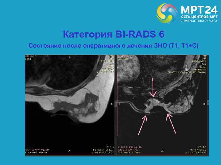 Категория BI-RADS 6 Состояние после оперативного лечения ЗНО (Т 1, Т 1+С) 