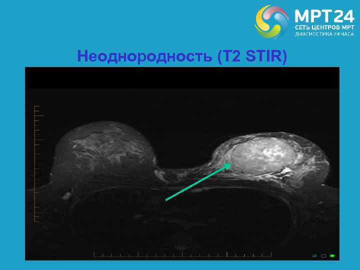 Неоднородность (Т 2 STIR) 