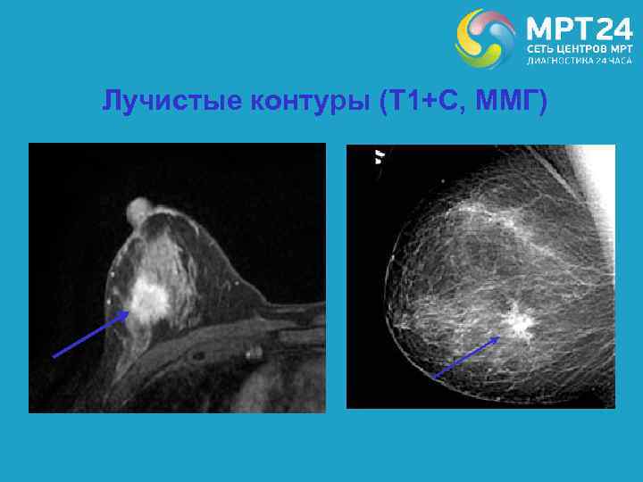 Лучистые контуры (Т 1+С, ММГ) 