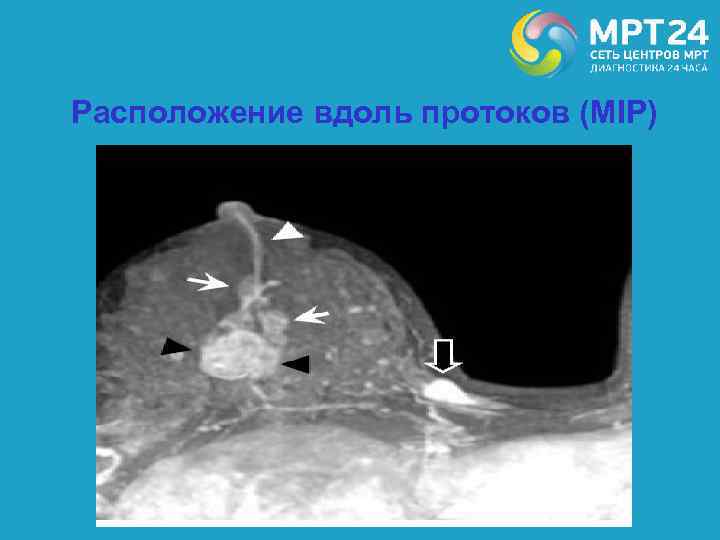 Расположение вдоль протоков (MIP) 