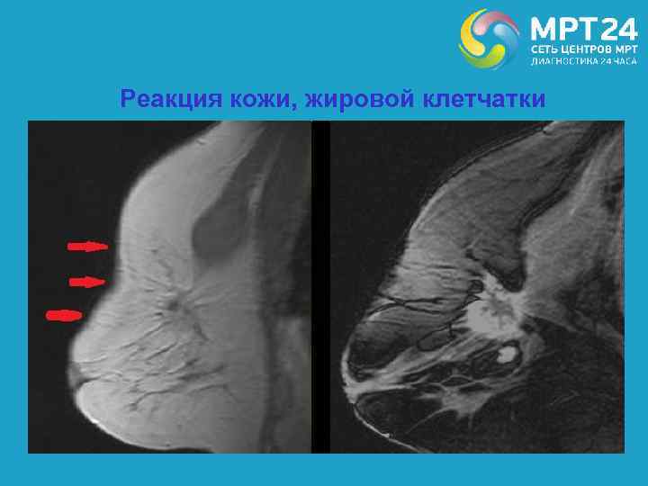 Реакция кожи, жировой клетчатки 