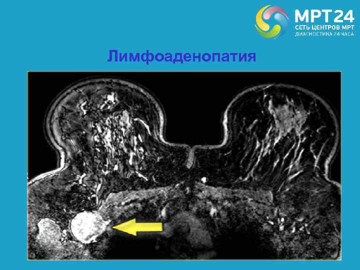 Лимфоаденопатия 