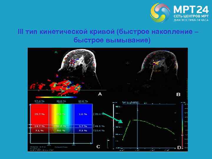 III тип кинетической кривой (быстрое накопление – быстрое вымывание) 