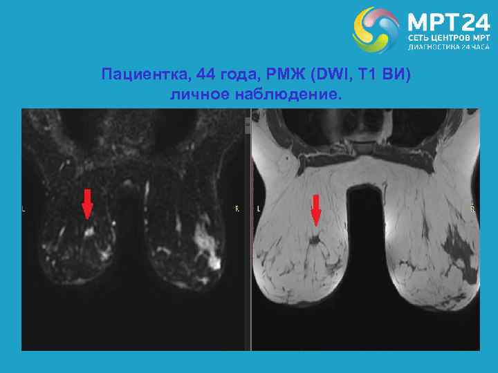 Пациентка, 44 года, РМЖ (DWI, T 1 ВИ) личное наблюдение. 