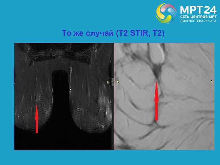 То же случай (Т 2 STIR, Т 2) 