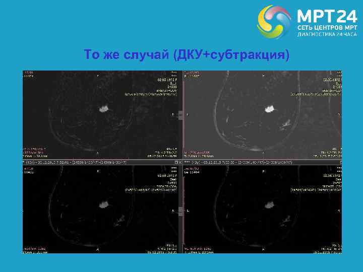 То же случай (ДКУ+субтракция) 