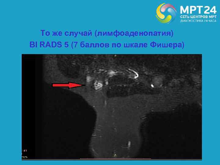То же случай (лимфоаденопатия) BI RADS 5 (7 баллов по шкале Фишера) 