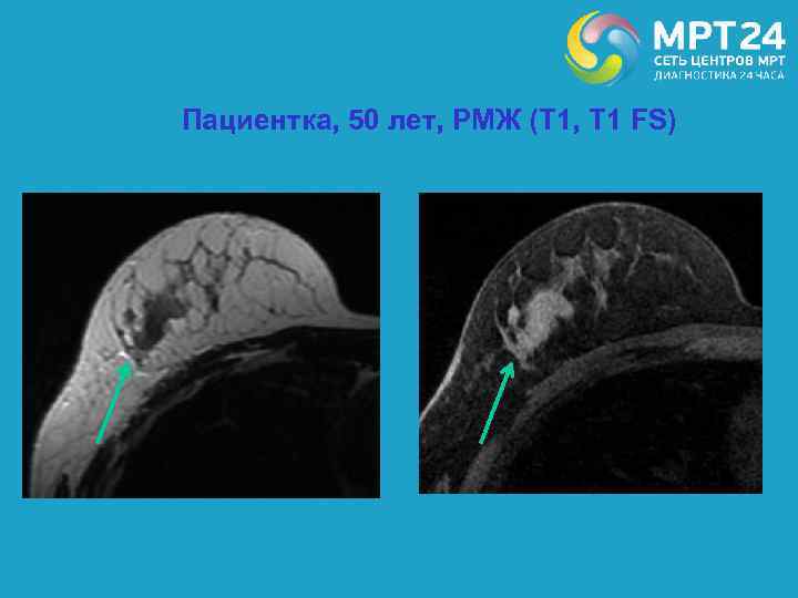 Пациентка, 50 лет, РМЖ (Т 1, Т 1 FS) 