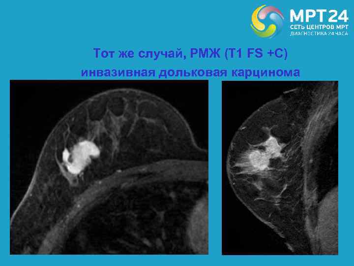 Тот же случай, РМЖ (Т 1 FS +С) инвазивная дольковая карцинома 