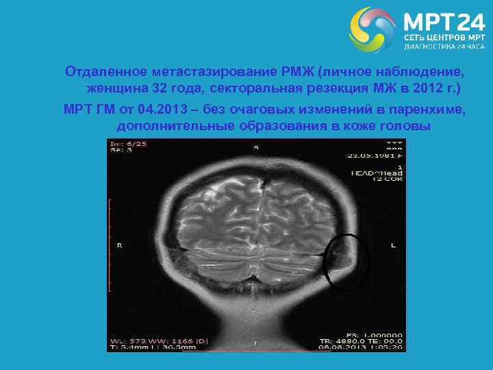 Отдаленное метастазирование РМЖ (личное наблюдение, женщина 32 года, секторальная резекция МЖ в 2012 г.