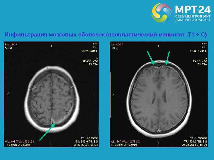 Инфильтрация мозговых оболочек (неопластический менингит , Т 1 + С) 