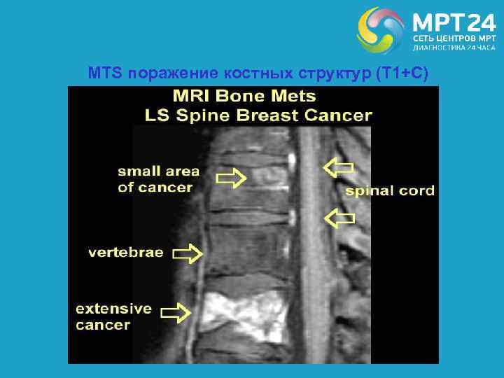 MTS поражение костных структур (Т 1+С) 