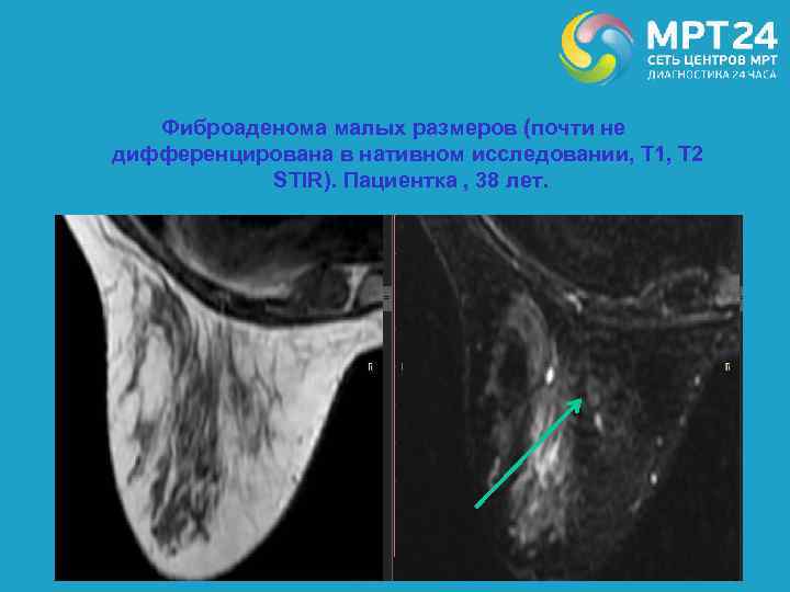 Фиброаденома малых размеров (почти не дифференцирована в нативном исследовании, Т 1, Т 2 STIR).