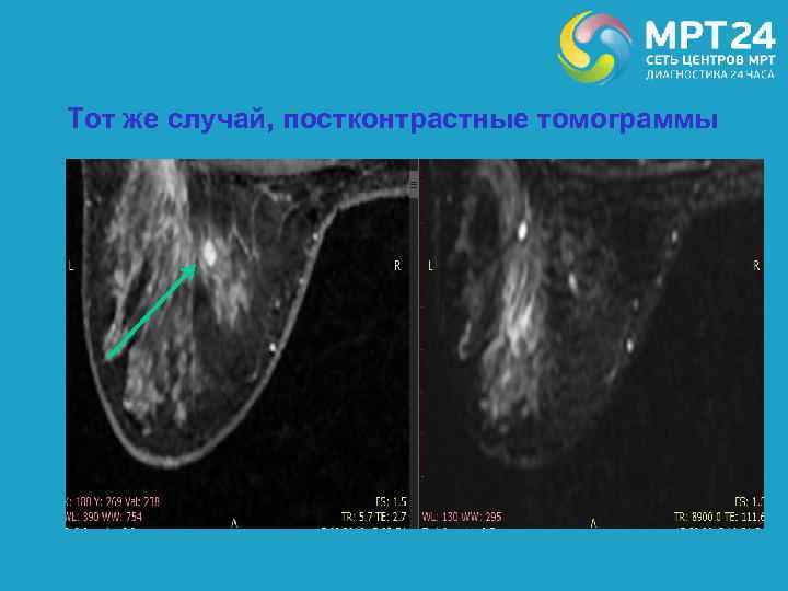 Тот же случай, постконтрастные томограммы 