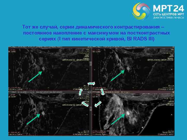 Тот же случай, серии динамического контрастирования – постоянное накопление с максимумом на постконтрастных сериях
