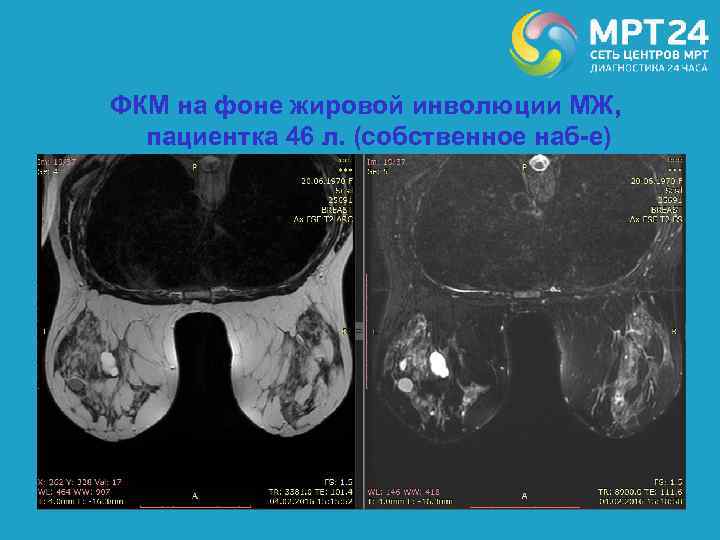ФКМ на фоне жировой инволюции МЖ, пациентка 46 л. (собственное наб-е) 