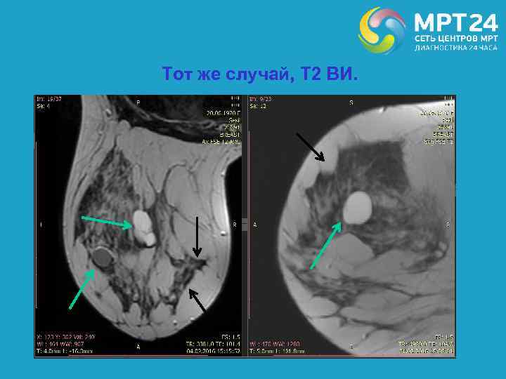 Тот же случай, Т 2 ВИ. 
