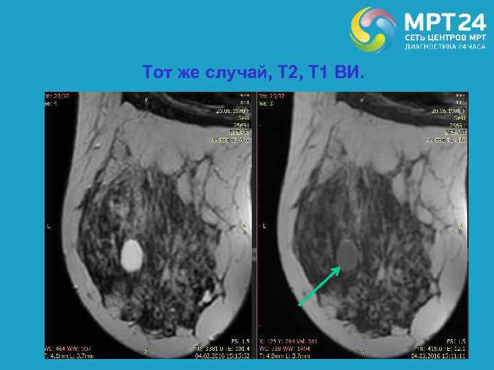 Тот же случай, Т 2, Т 1 ВИ. 