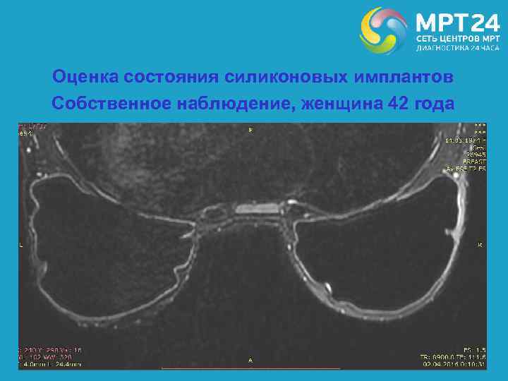 Оценка состояния силиконовых имплантов Собственное наблюдение, женщина 42 года 