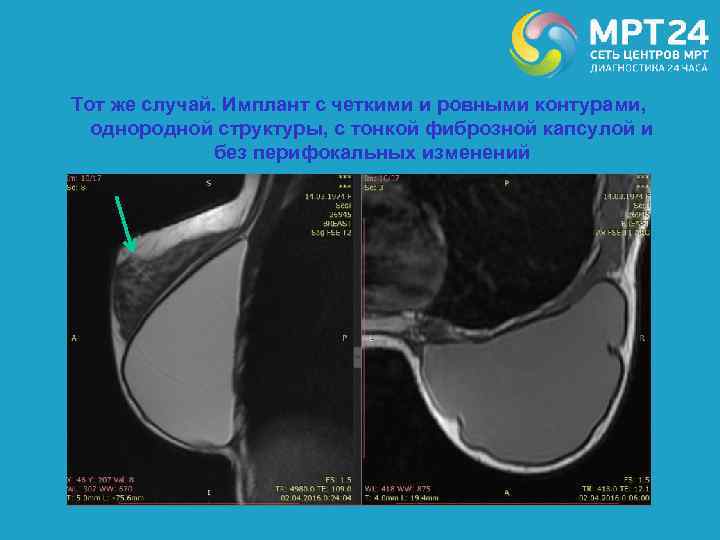 Тот же случай. Имплант с четкими и ровными контурами, однородной структуры, с тонкой фиброзной
