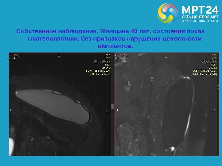 Собственное наблюдение. Женщина 40 лет, состояние после глютеопластики, без признаков нарушения целостности имплантов. 