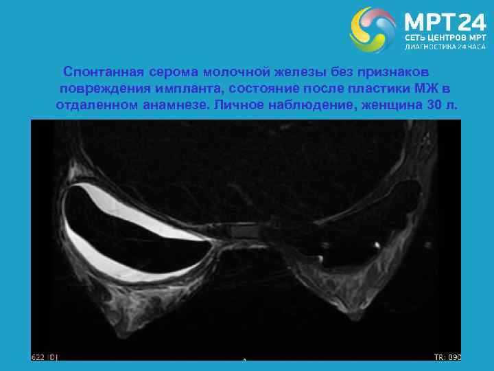 Спонтанная серома молочной железы без признаков повреждения импланта, состояние после пластики МЖ в отдаленном